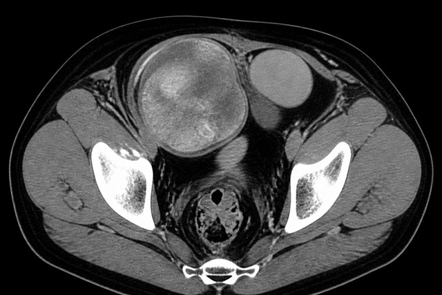 Cirugía oncológica de tumores testiculares y de pene en Pontevedra - Imagen 1