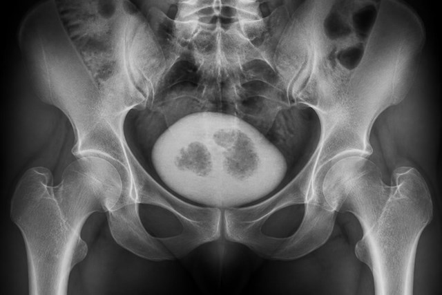 Cirugía urológica para cáncer de vejiga en Pontevedra - Imagen 1