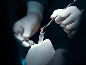 Diagnóstico del cáncer de próstata: biopsia y otras técnicas