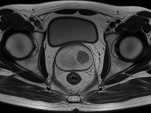 Hormonoterapia para cáncer de próstata en Pontevedra