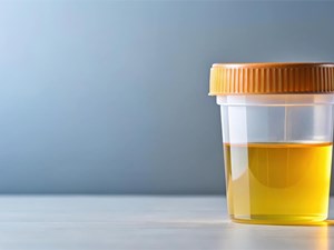 Sangre en la orina: ¿Cuándo es urgente ir al médico y cuándo puede esperar?